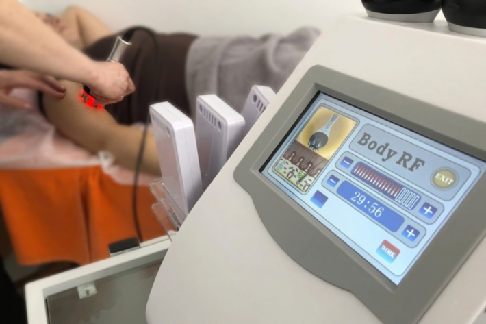 Radiofrekvences liftings